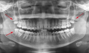 Wisdom-Tooth-Extraction-X-Ray